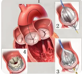 經(jīng)導管瓣中瓣系統(tǒng)viv-19代理