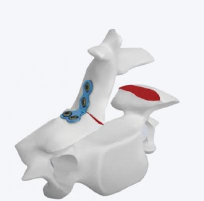 椎板固定板系統(tǒng)代理