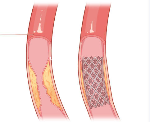 直管型胸主動(dòng)脈覆膜支架系統(tǒng) 廠(chǎng)家